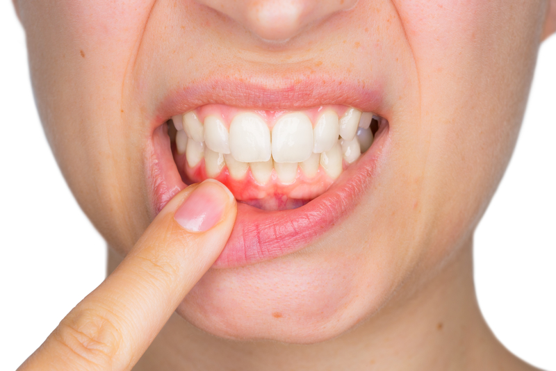 dental-gum-disease